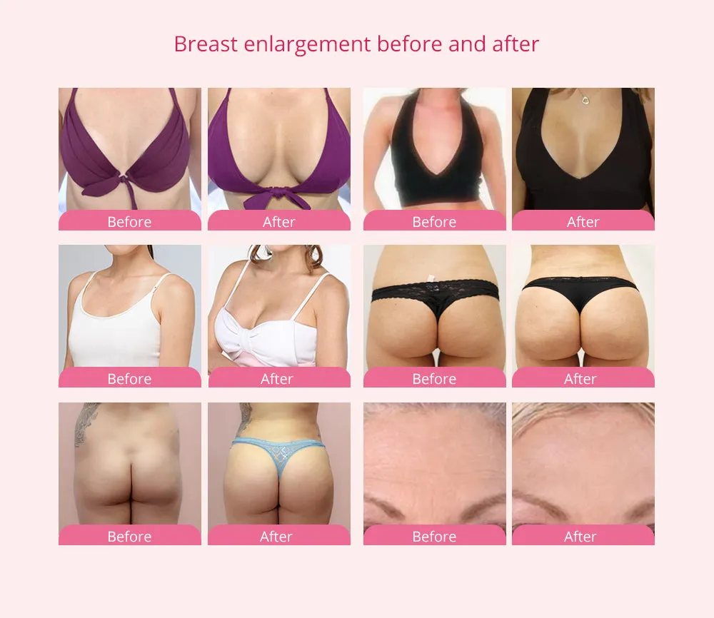 S Curve Suck-Lipo Breast Enhancement Breast Lifting Lipo Laser Slimming Machine